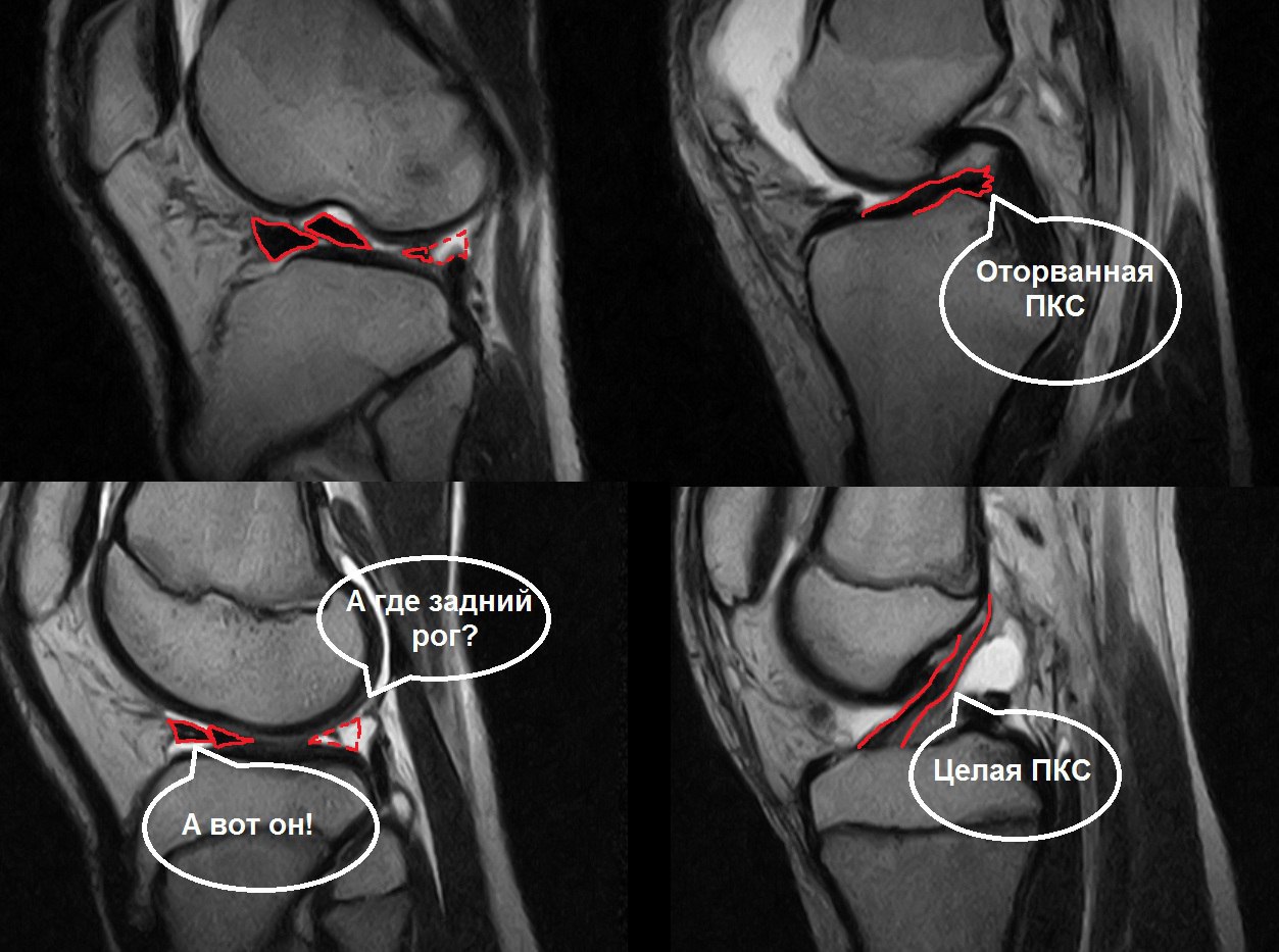 Мрт коленного сустава картинки