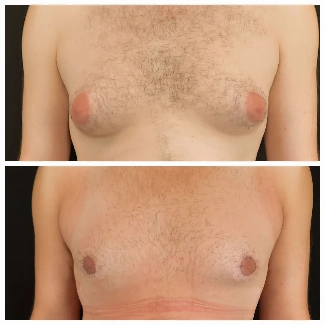 удаления жира из груди у мужчин фото 18