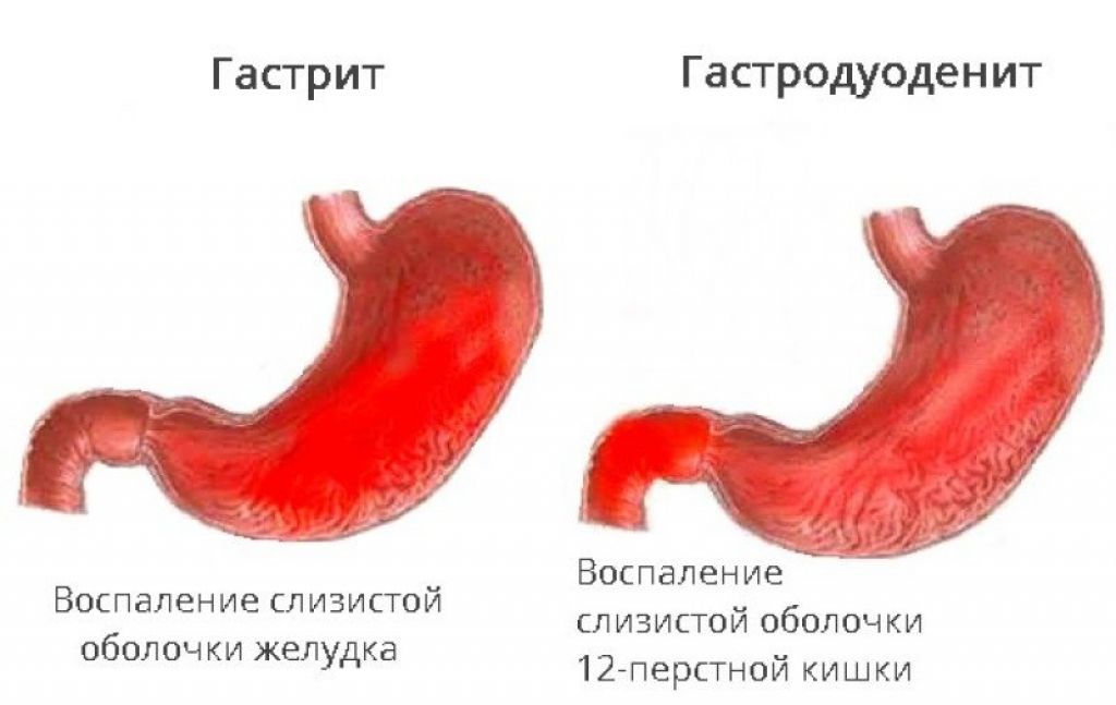 Дискинезия 12 перстной кишки