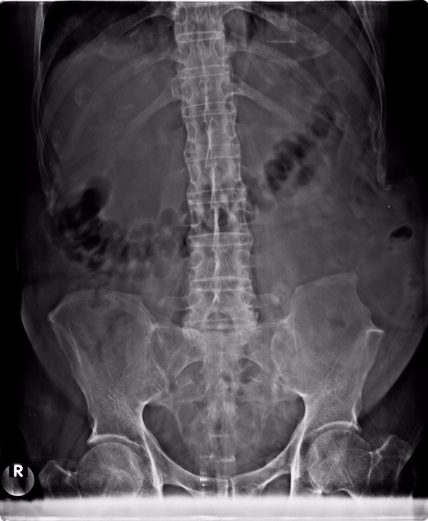 Анкилозирующий спондилит – Telegraph