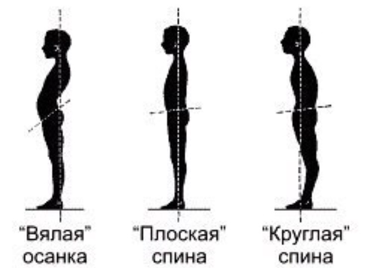 Что значит плоский. Плоская спина. Круглая плоская спина. Осанка плоская спина. Выпрямленная осанка (плоская спина).