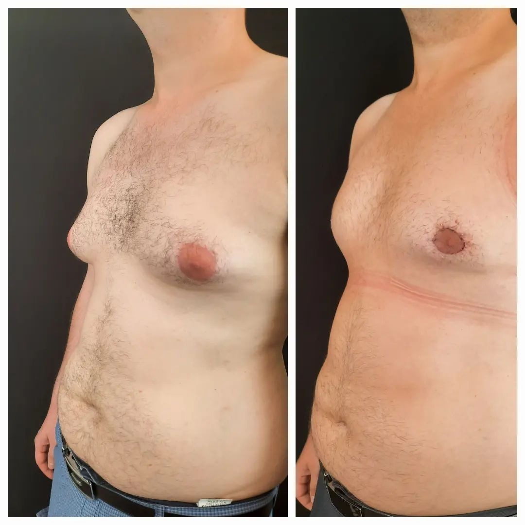 удаления жира из груди у мужчин фото 37