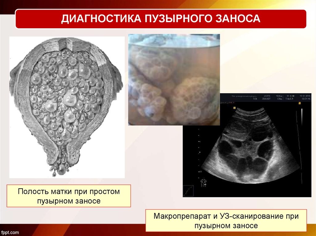 Пузырный занос. Деструирующий пузырный занос на УЗИ. Инвазивный пузырный занос на УЗИ. Деструирующий пузырный занос клиника. Частичный пузырный занос на УЗИ.