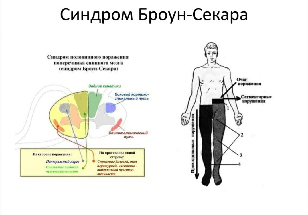 Синдром броун секара это. Синдром поражения половины поперечника спинного мозга. Синдром половинного поражения спинного мозга Броун Секара. Синдром Броун-Секара развивается при поражении:. Синдром поперечного поражения спинного мозга на различных уровнях.