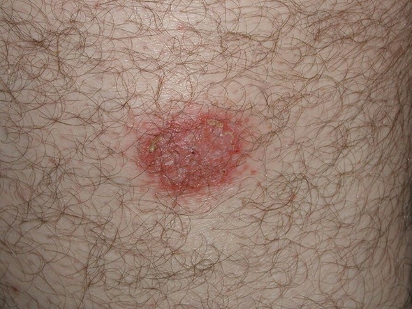 Нуммулярная (монетовидная) экзема – Telegraph