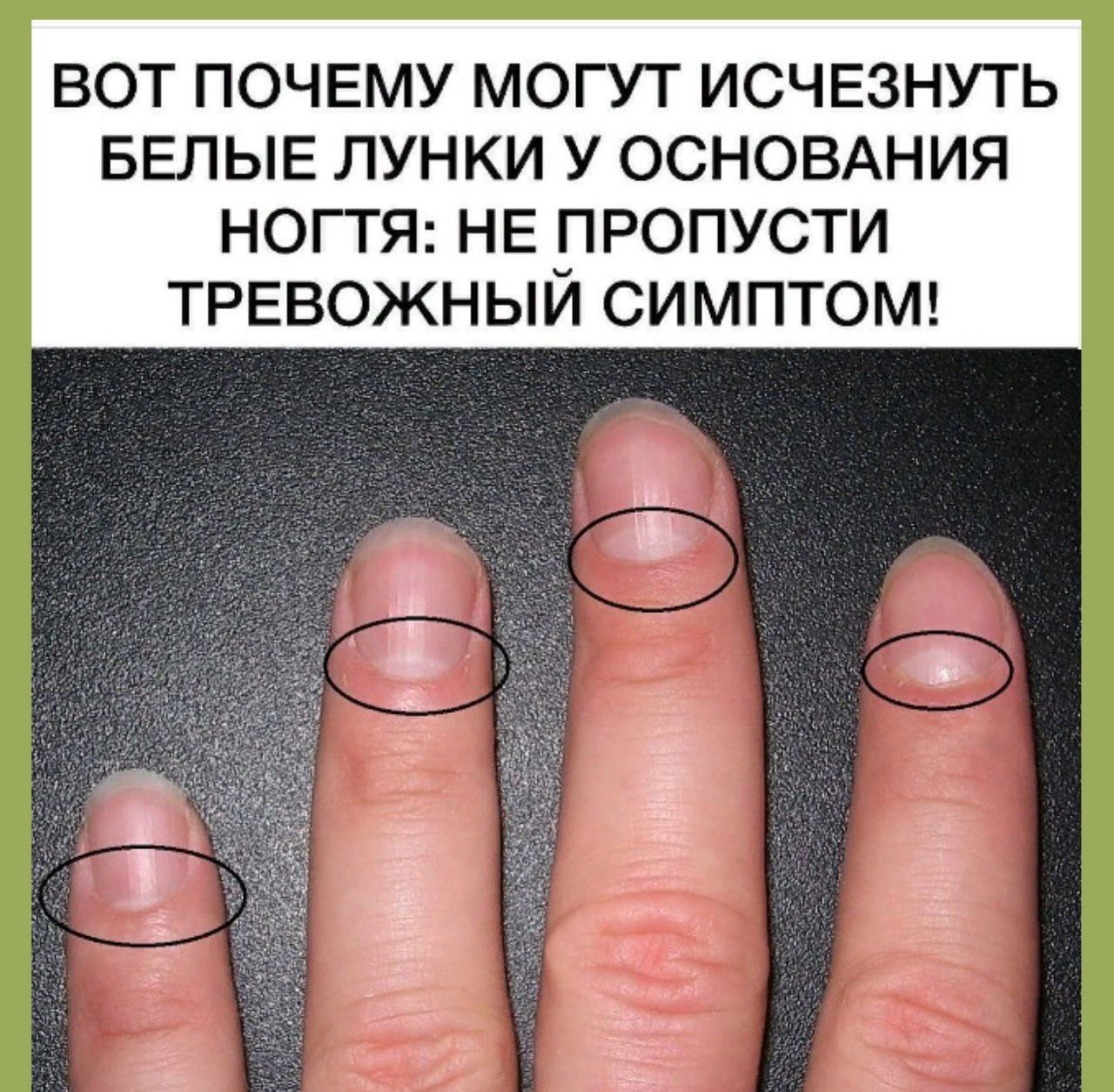 Большие лунки на ногтях рук