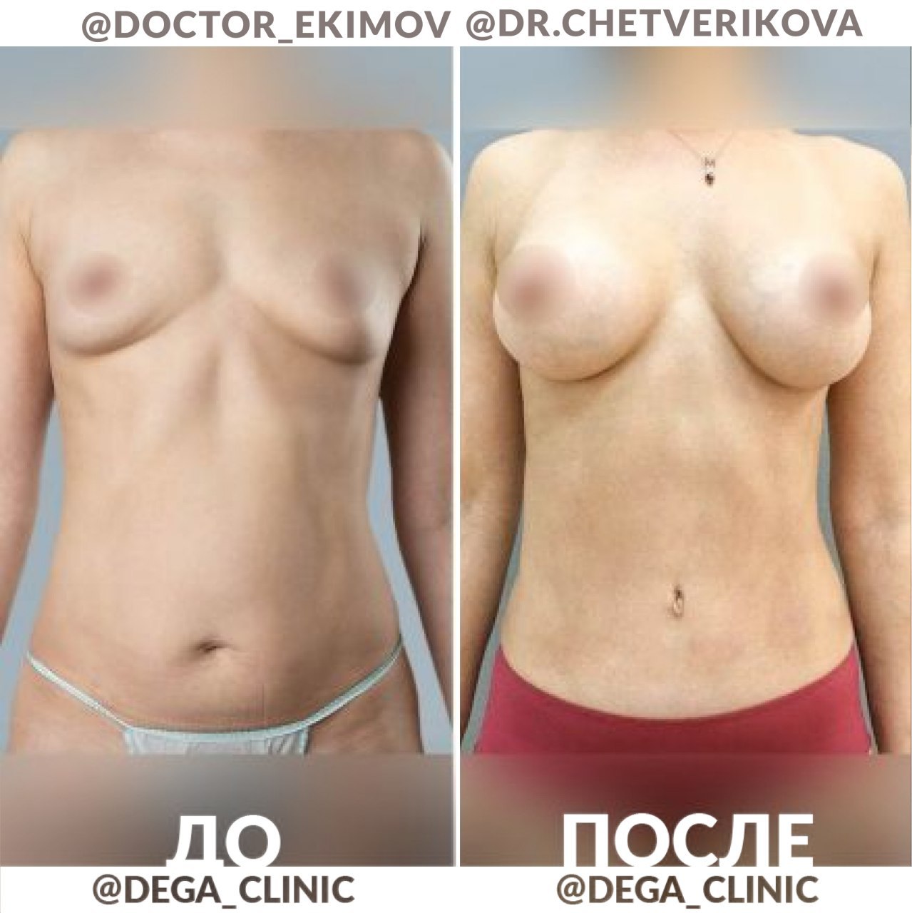асимметрия груди у женщин форум фото 117