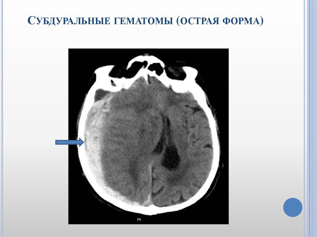 Субдуральная гематома. Эпи субдуральная гематома кт. Подострая субдуральная гематома кт. Конвекситальная субдуральная гематома. Острая субдуральная гематома кт.