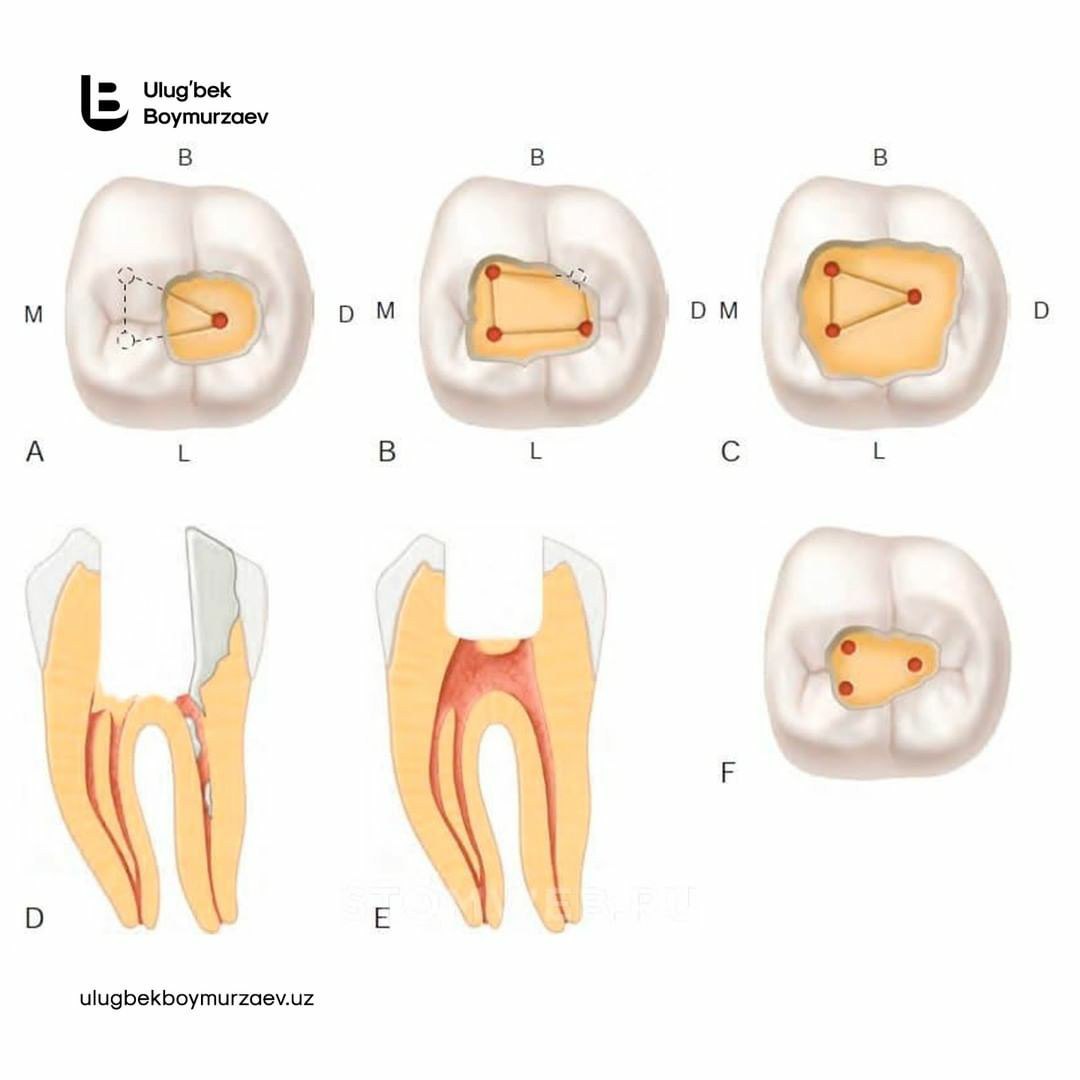 Препарирование корневого канала. Анатомия устьев корневых каналов 26 зуба. Каналы 46 зуба анатомия корневые. 1 Моляр нижней челюсти эндодонтия. Расположение корневых каналов в 47.