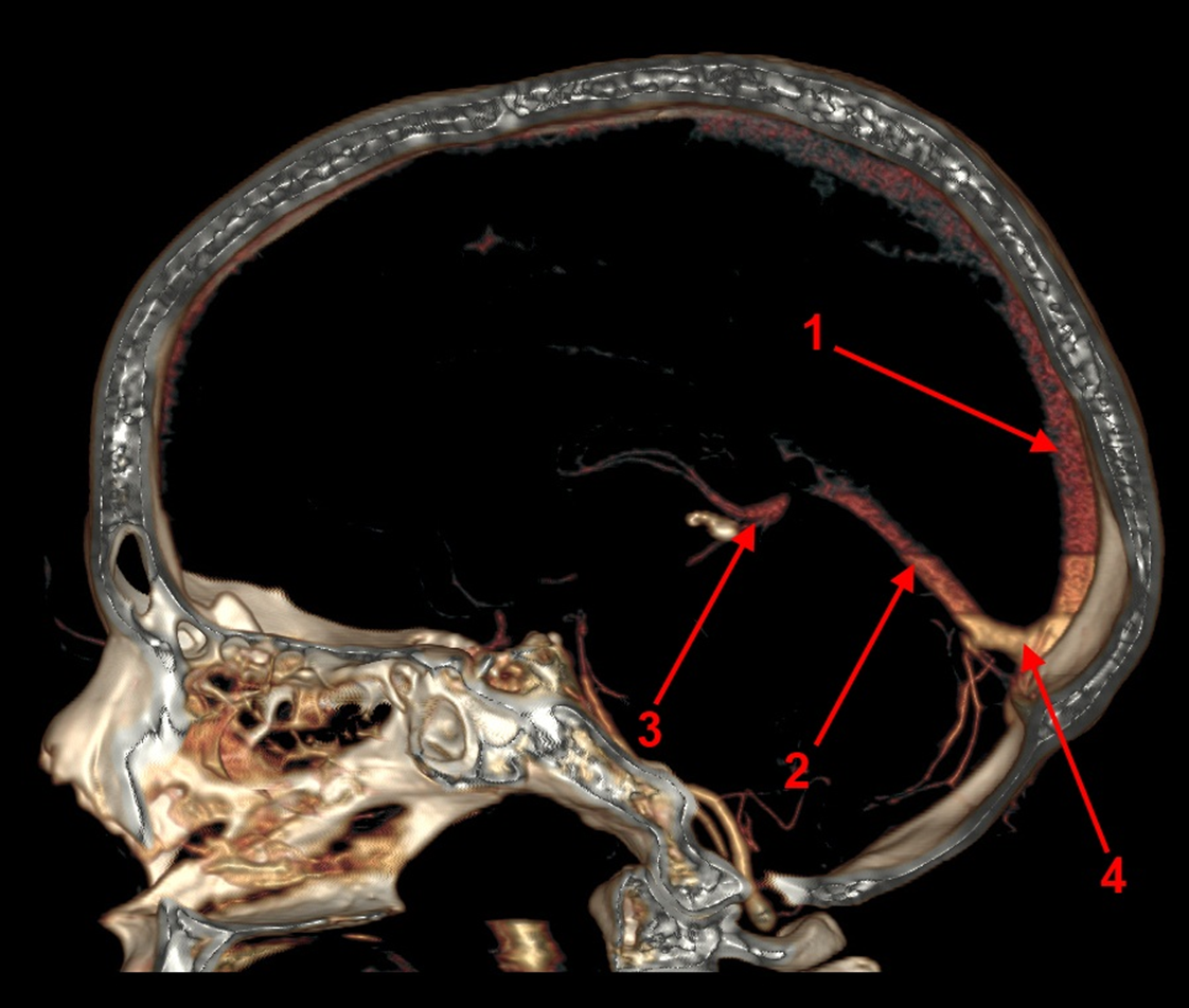 Гипоплазия правого поперечного синуса. Тромбоз сигмовидного синуса на кт. Верхний Сагиттальный синус головного мозга кт анатомия. Тромбоз поперечного синуса кт.