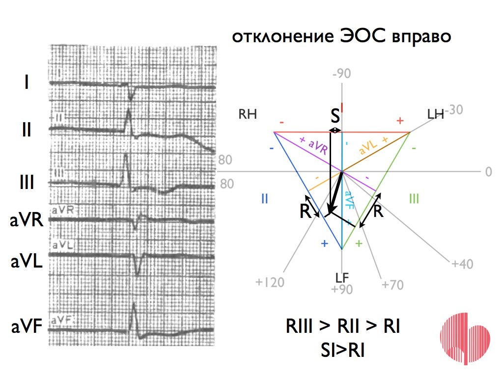 Электрическая ось сердца горизонтальная