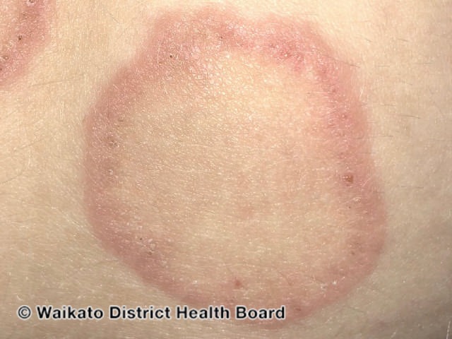 Кольцевидная центробежная эритема Дарье – Telegraph