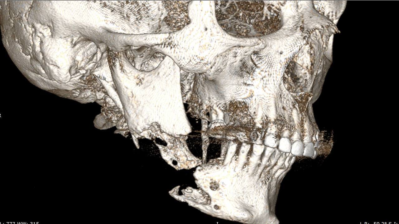 Хабаровчанке пришлось восстанавливать челюсть после удаления зуба