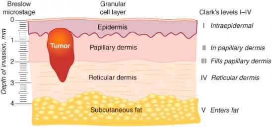 Меланома толщина по бреслоу. Инвазия по Кларку меланома. По Бреслоу. Меланома по Кларку.