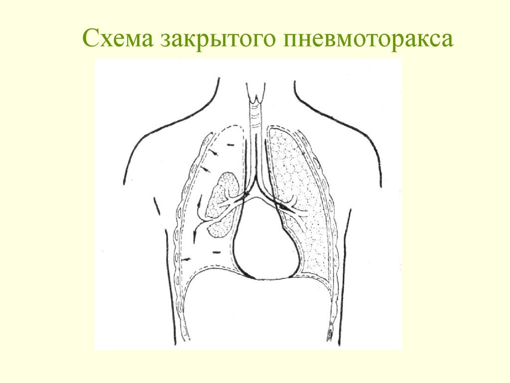 Закрытый пневмоторакс это