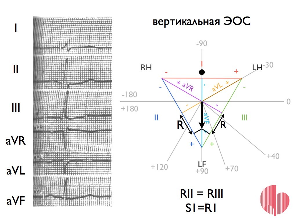 Электрическая ось сердца на экг