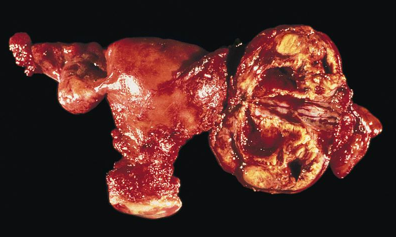 PID nedeniyle tuboovarian apse oluşmuş genital sistem , rahim yumurtalıklar pert halde, östrojen sarhoşluğuna bağlı aşırı ihmal edilmiş jinekolojik sistem 