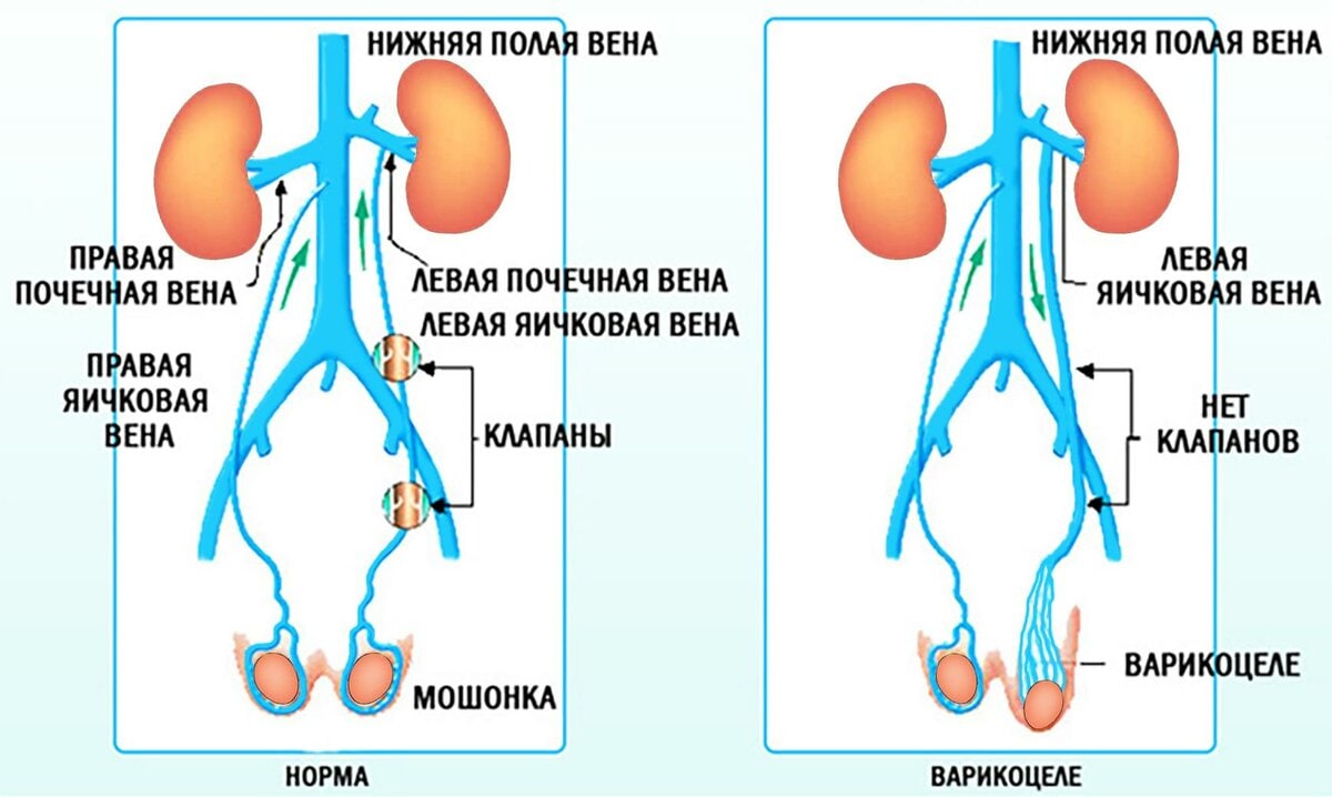 Варикоцеле отзывы мужчин