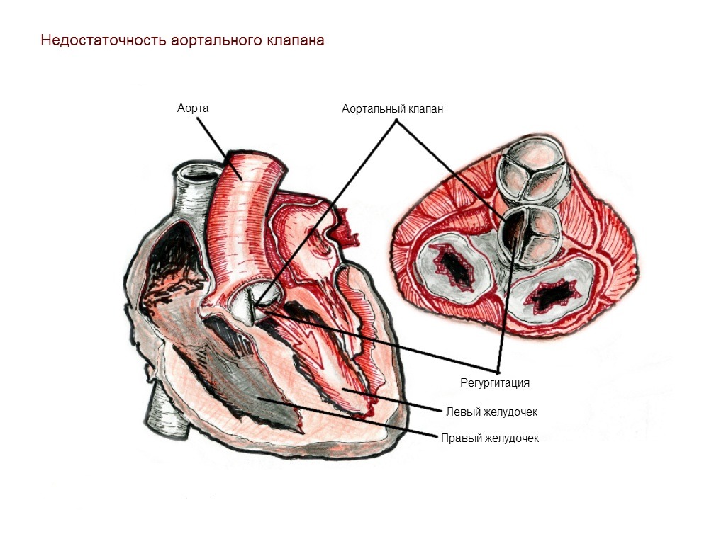 Аортальная недостаточность регургитация. Недостаточность аортального клапана. Недостаточность аортального клапана 1. Недостаточность аортального клапана рисунок. Недостаточность клапана аорты степени.