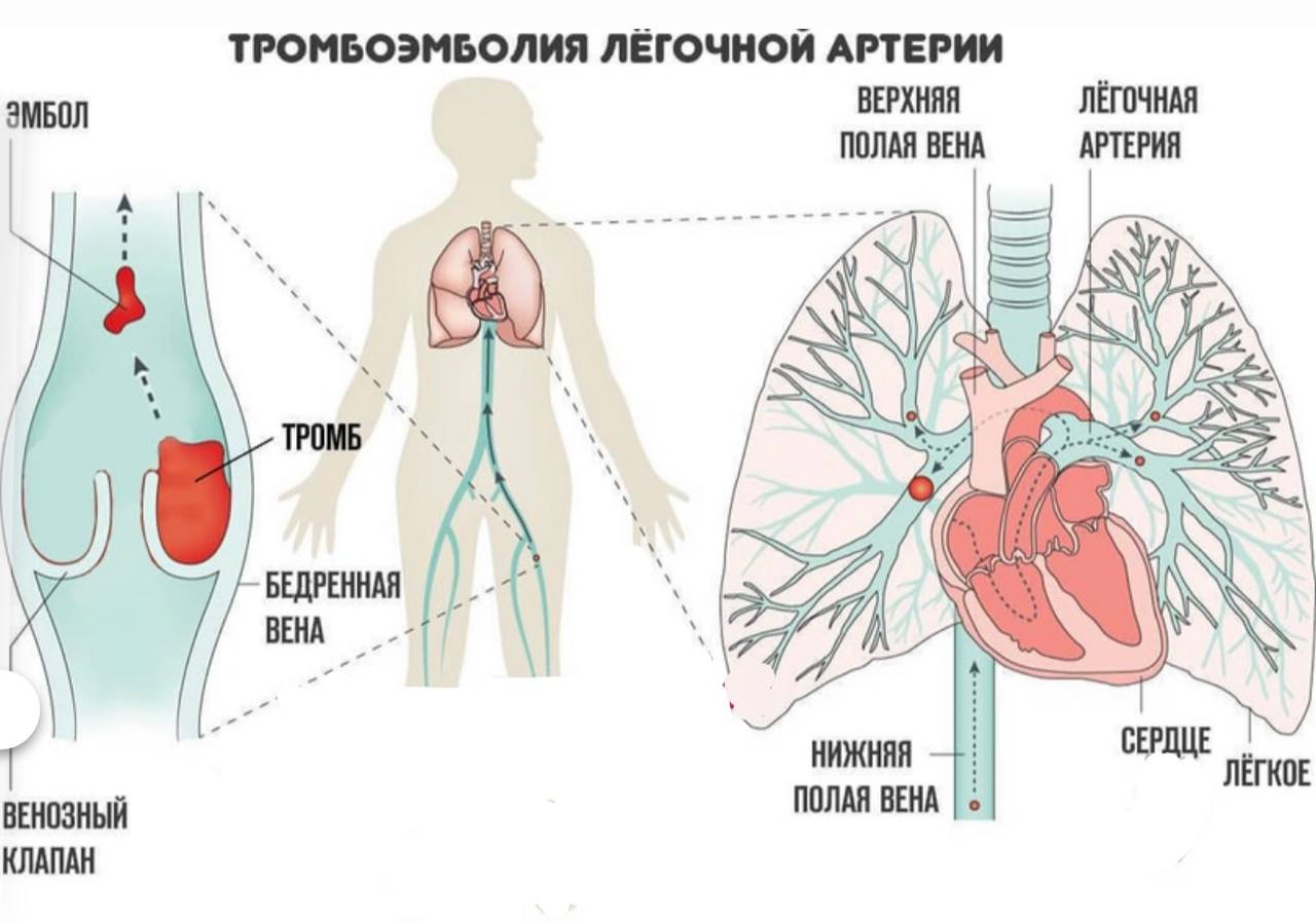 Артериальная тромбоэмболия