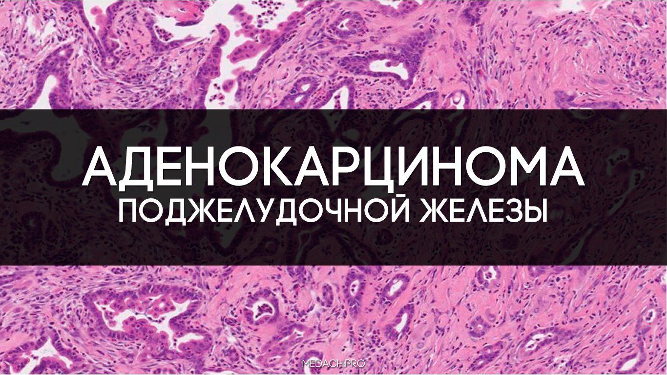 Аденокарцинома железы. Аденокарцинома поджелудочной железы гистология. Аденокарцинома поджелудочной гистология. Протоковая аденокарцинома поджелудочной железы гистология. Высокодифференцированная аденокарцинома поджелудочной железы.