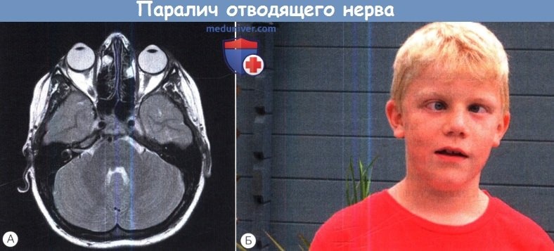 Паралич 3 пары черепных нервов. Глазодвигательный парез. Паралич отводящего нерва симптомы. Ядерный паралич отводящего нерва. Поражение блокового нерва сходящееся косоглазие.