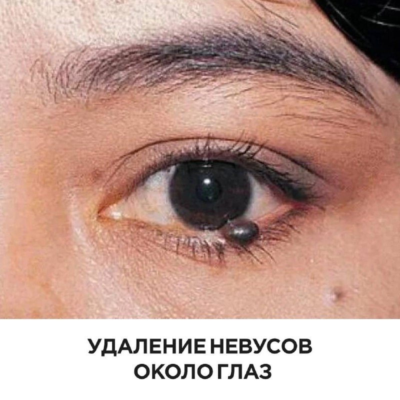 Левый глаз темнее правого. Пигментный меланоз склеры. Базалиома межресничная. Узловая меланома Радужки. Пигментный невус склеры.