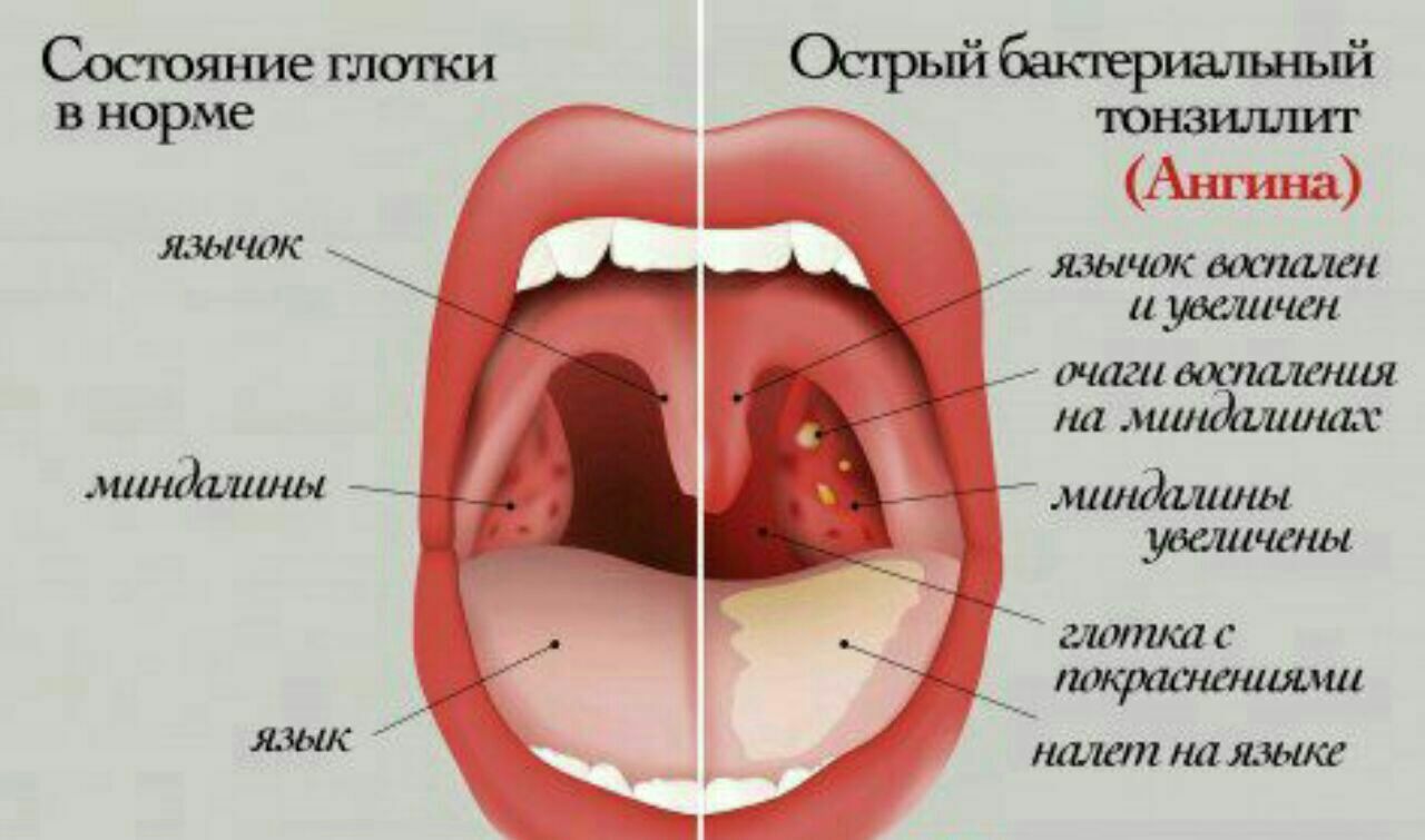 Острый катаральный тонзиллит