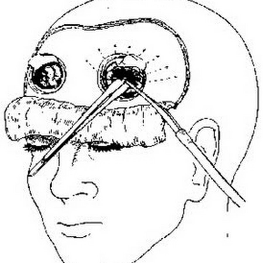 В мозг через глаза. Трансорбитальная Лоботомия. Транс орбитальная Лоботомия. Префронтальная Лоботомия Эгаш Мониш.