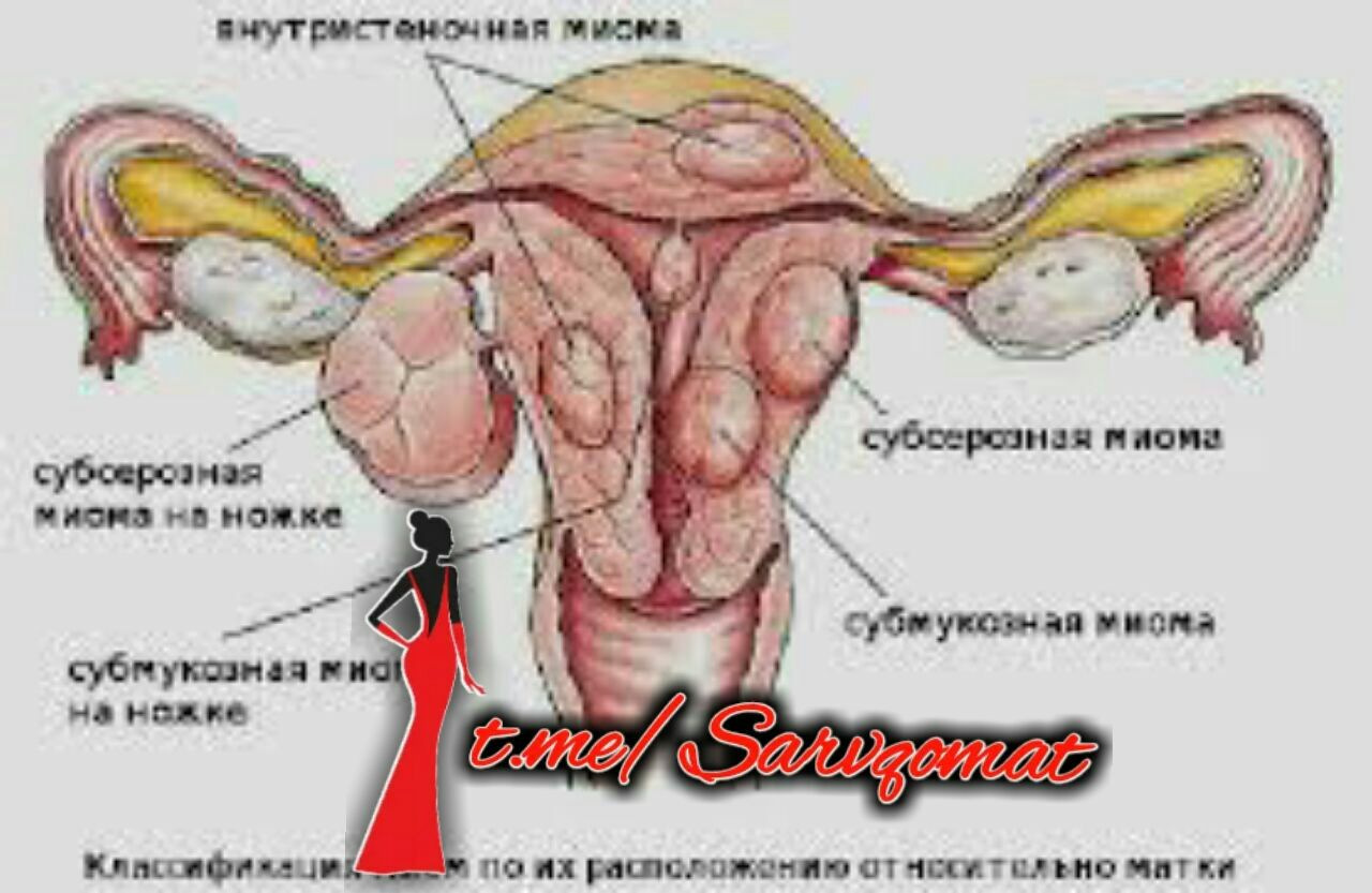 миома кончить можно фото 79