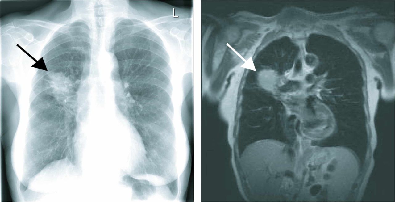 Рентгеновская томограмма грудной клетки