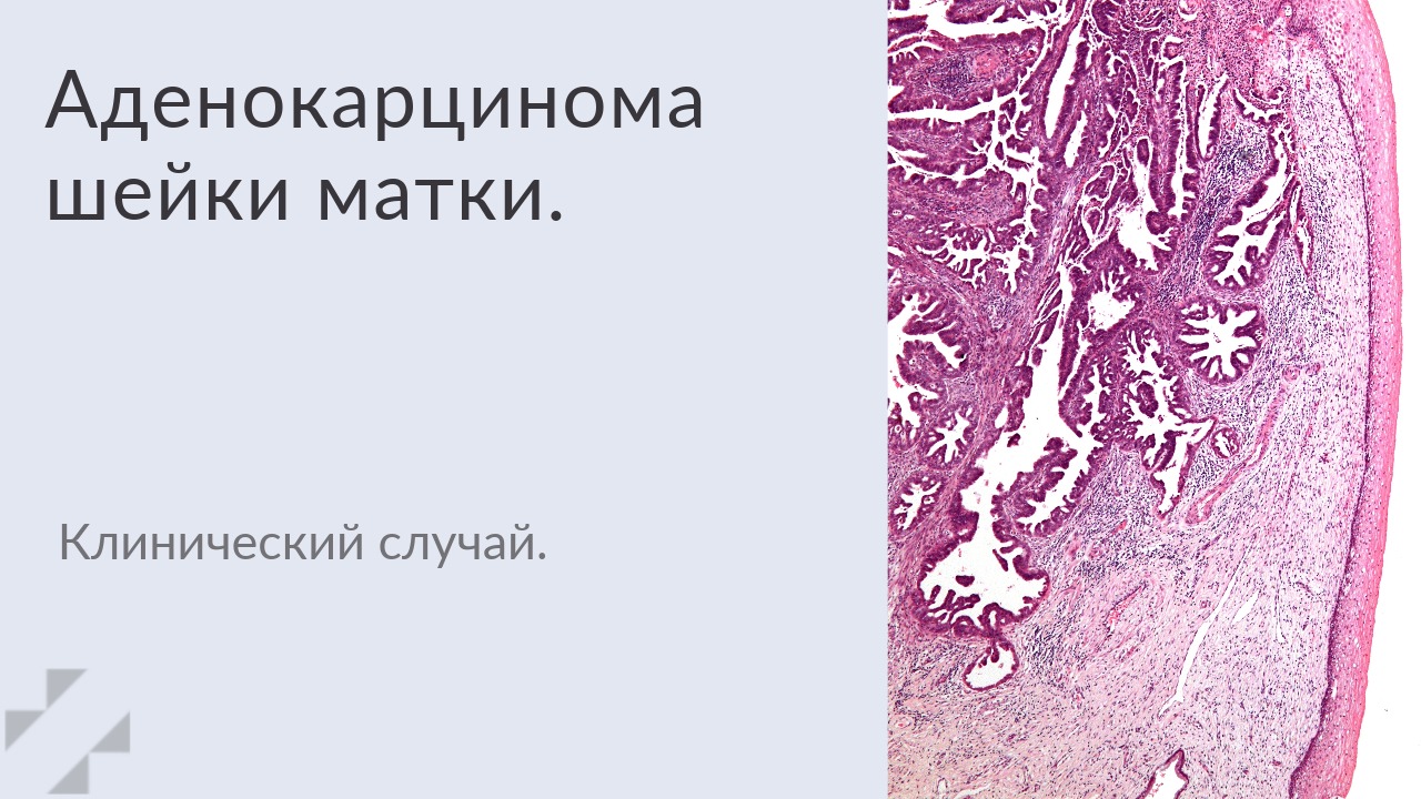 Аденокарцинома шейки матки. – Telegraph