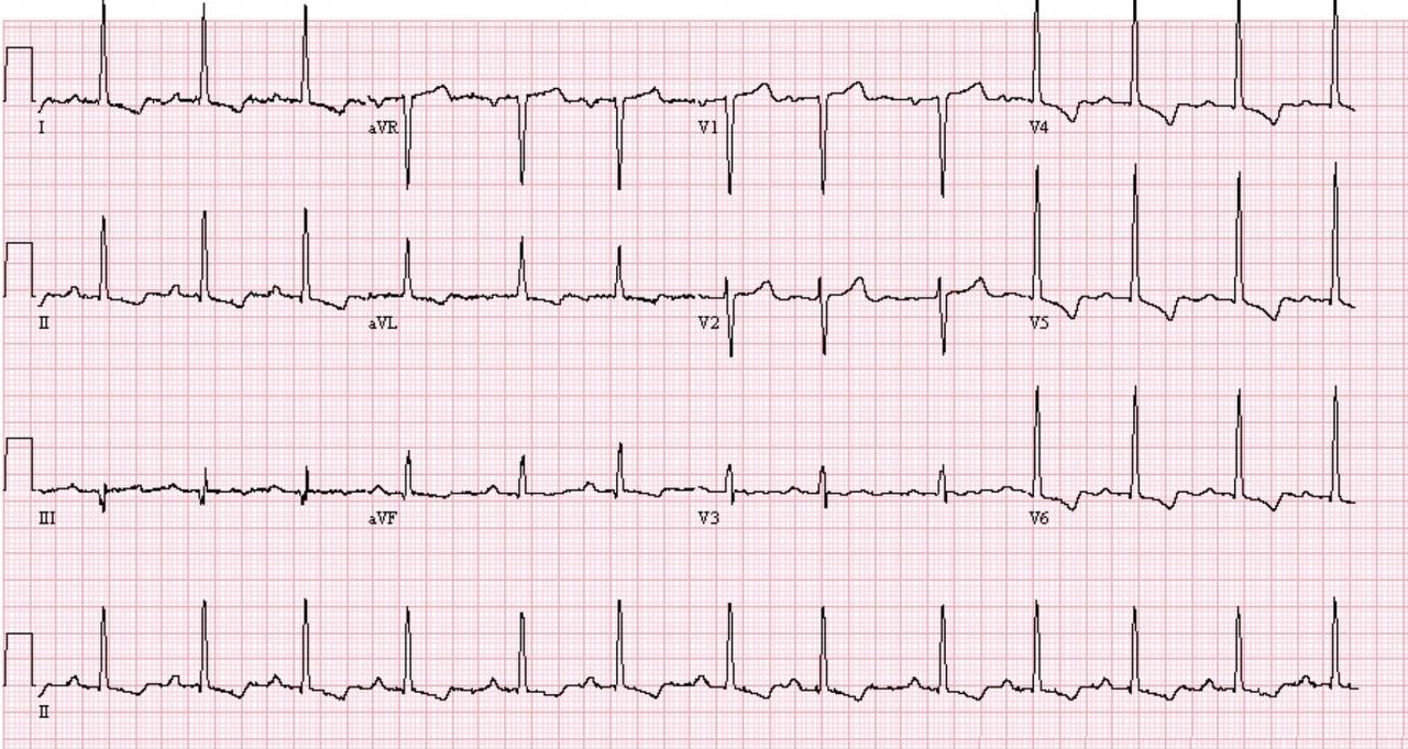 Синусовая аритмия на экг. ЭКГ при АВ блокаде 1 степени. Блокада АВ узла на ЭКГ. ЭКГ ритм синусовый блокада 1 гипертрофия левого желудочка. На ЭКГ АВ блокада 1 степени, тахикардия синусовая.