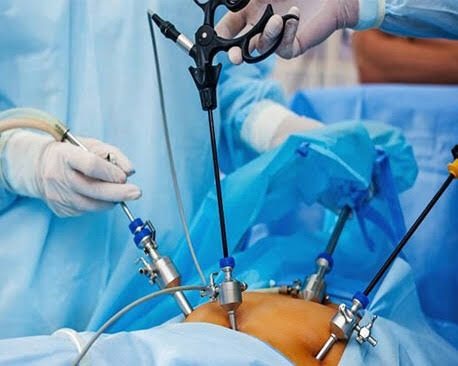 What is Laparoscopic and GERD Surgery? 