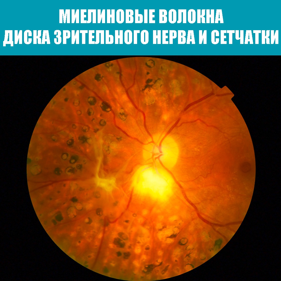 МИЕЛИНОВЫЕ ВОЛОКНА – Telegraph