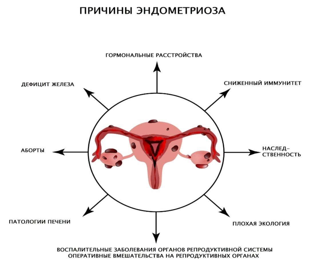 Признаки эндометриоза