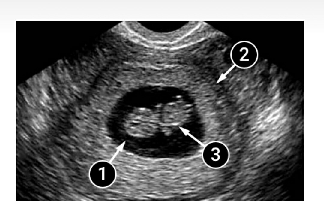 Шейка 6 недель. Как выглядит зародыш в 6 недель на УЗИ. УЗИ на 7 акушерской неделе беременности.