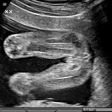 ultrasonda kız cinsiyet