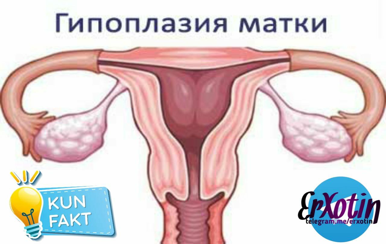 1 матка. Гипоплазия матки 1 степени. Гинекология гипоплазия матки что это такое. Гипоплазия матки на УЗИ.