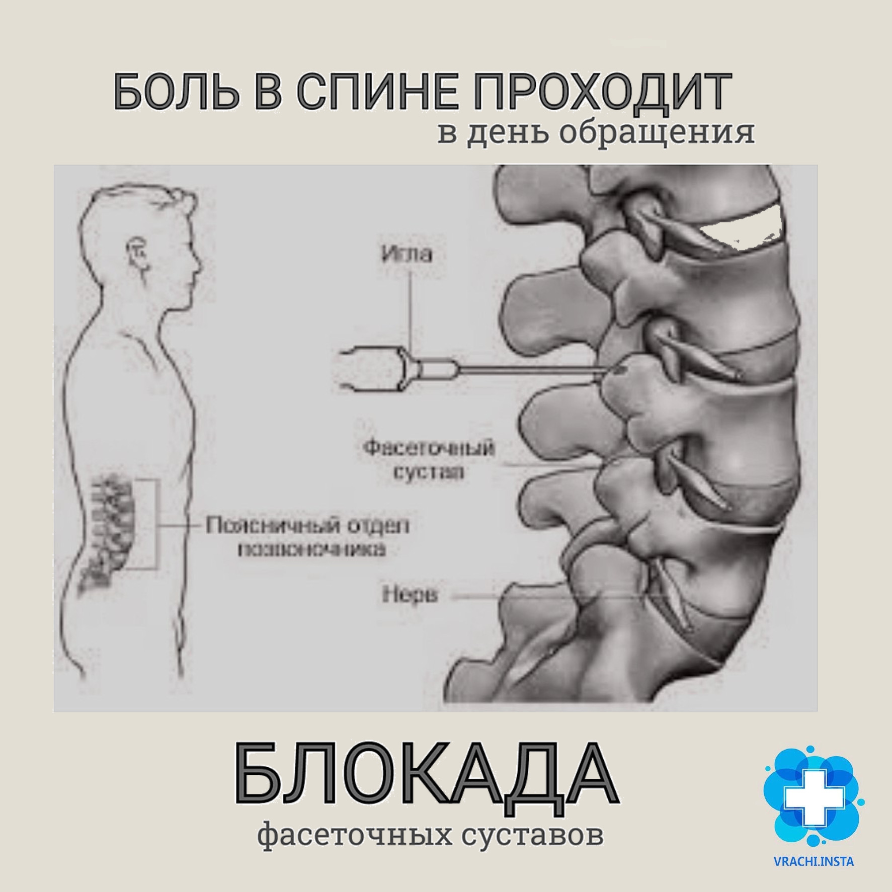 Фасеточная блокада. Блокада фасеточных суставов. Фасеточные суставы позвоночника. Блокада фасеточных суставов поясничного отдела позвоночника. Блокада фасеточного сустава методика.