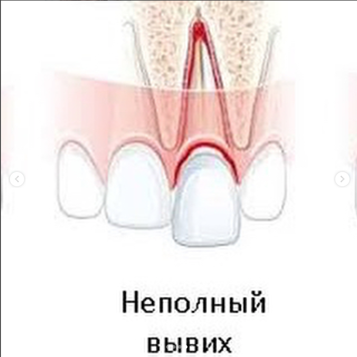 Температура после удаление. Неполный вывих молочного зуба. Неполный вывих зуба рентген.