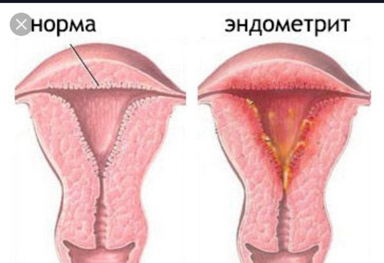 Месячные с кусками эндометрия