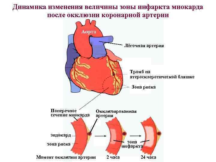 Коронарная окклюзия