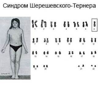 45 хромосом. Синдром Шерешевского-Тернера кариотип и фенотип больных. Синдром Шерешевского Тернера дифференциальный диагноз. Шерешевского-Тернера хромосомное заболевание.