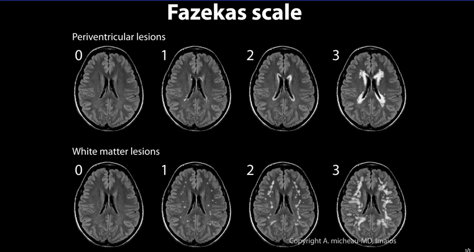 Церебральная микроангиопатия fazekas