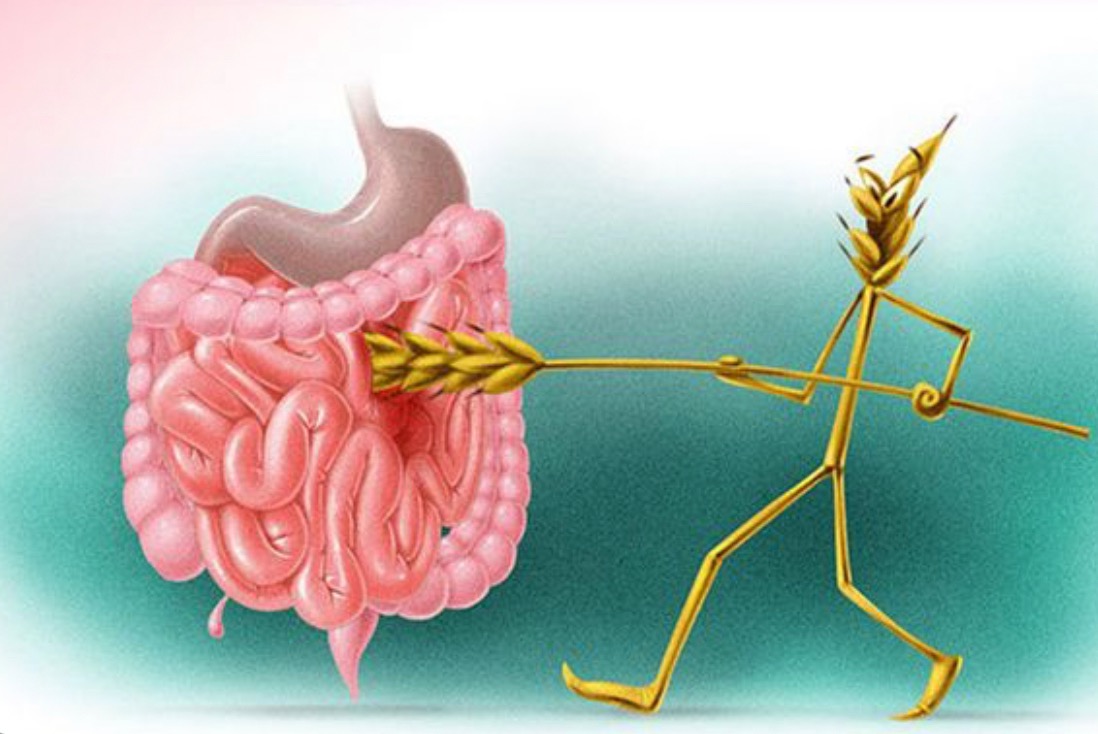ОПИСАНИЕ КЛИНИЧЕСКОГО СЛУЧАЯ СЕРОНЕГАТИВНОЙ ЦЕЛИАКИИ У ДЕВОЧКИ 5 ЛЕТ ...