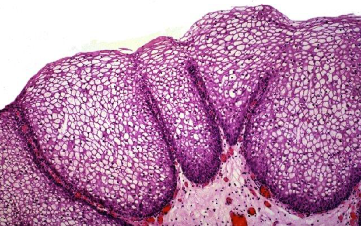 Лейкоплакия: подробный разбор – Telegraph