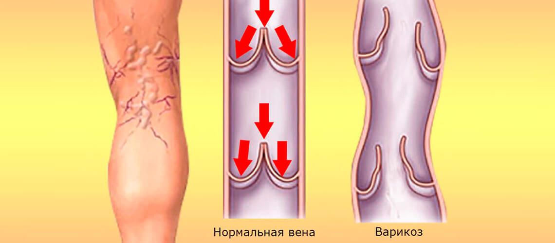 Варикозное Расширение Вен