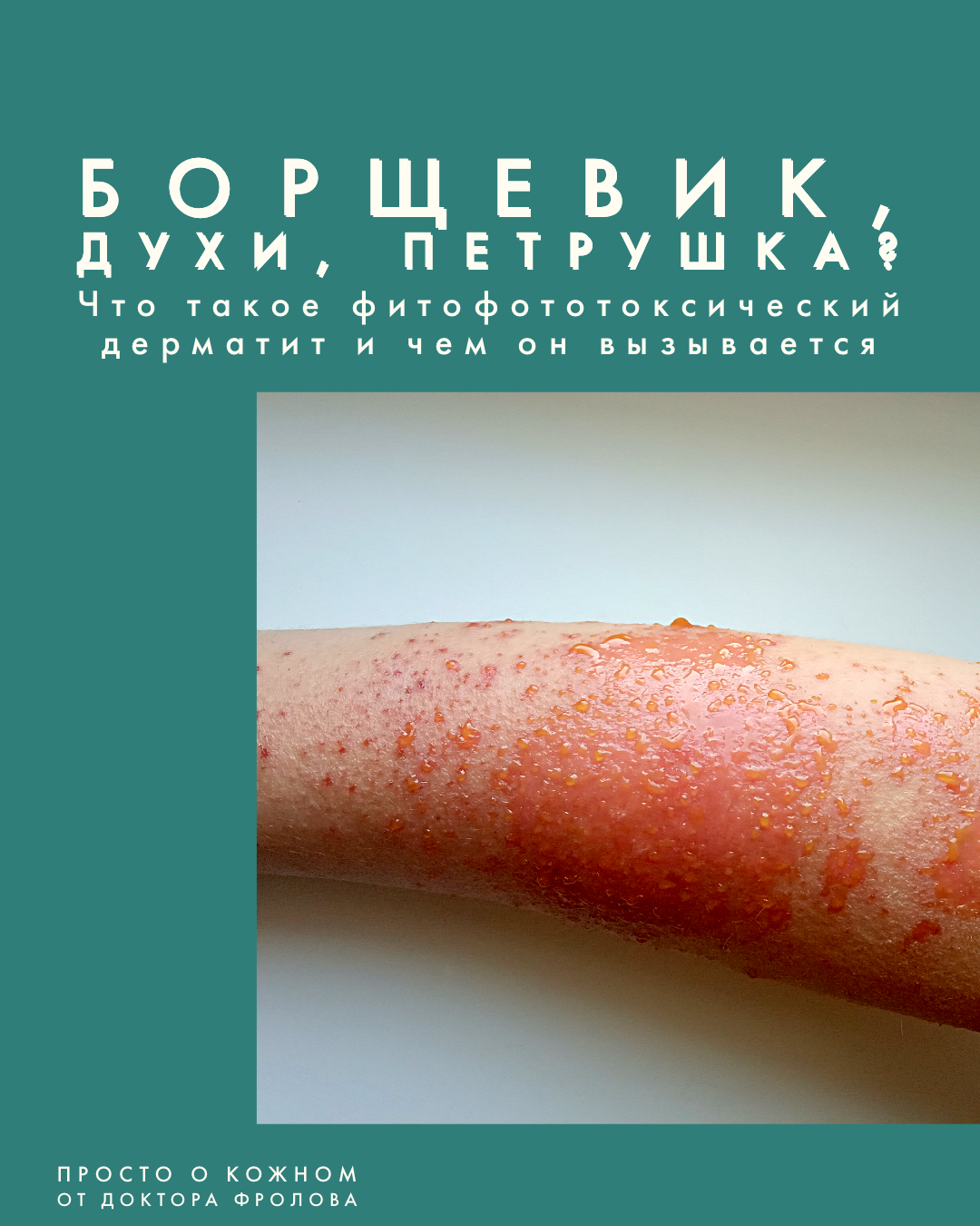 ФИТОФОТОДЕРМАТИТ – Telegraph