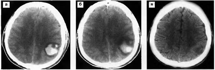 Гематома головного мозга рассасывается. Внутримозговая гематома кт. Кт внутримозговая гематома головного мозга. Подострая внутримозговая гематома на кт. Внутримозговая гематома при ЧМТ кт.